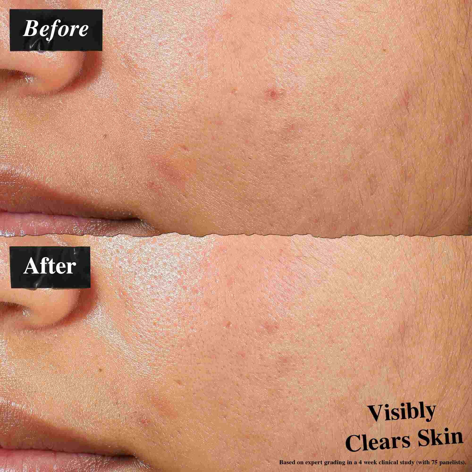 Ein Vorher-Nachher-Vergleich, der mit Expertly Clear Blemish-Treating & Preventing Lotion behandelte Haut zeigt. Das „Vorher“-Bild zeigt Hautunreinheiten und unebene Hauttextur, wahrend das „Nachher“-Bild sichtbar reinere Haut zeigt.