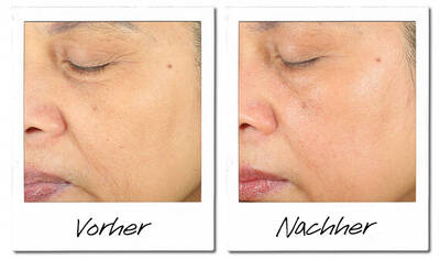vorher Nachher Bild
