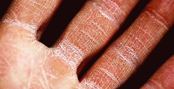 Rissige Handinnenflachen