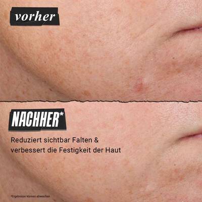Vorher-Nachher-Bild: Nahaufnahme einer weiblichen Stirn – Stirnfalten sind nach 12 Wochen Anwendung des Retinol-Serums sichtlich gemildert.