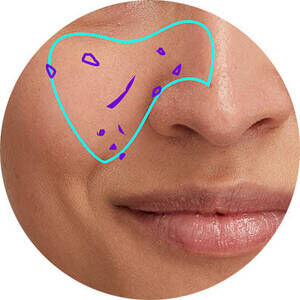 Derma Reader von Kiehl's: Analyse der Pickelmale