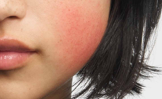 Wange einer Frau mit Rotung und Hautrotungen, wie sie bei Rosazea typisch sind