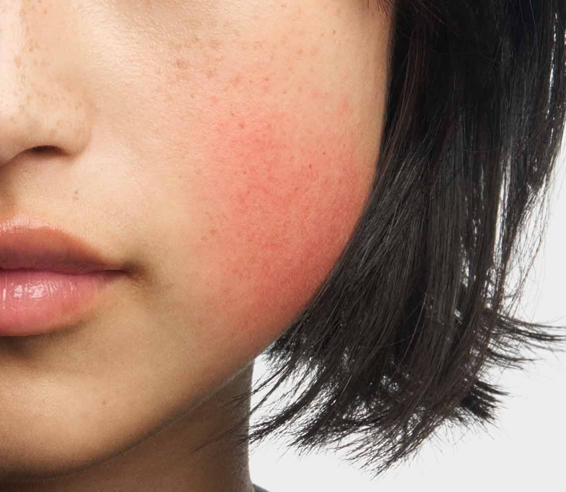 Wange einer Frau mit Rotung und Hautrotungen, wie sie bei Rosazea typisch sind
