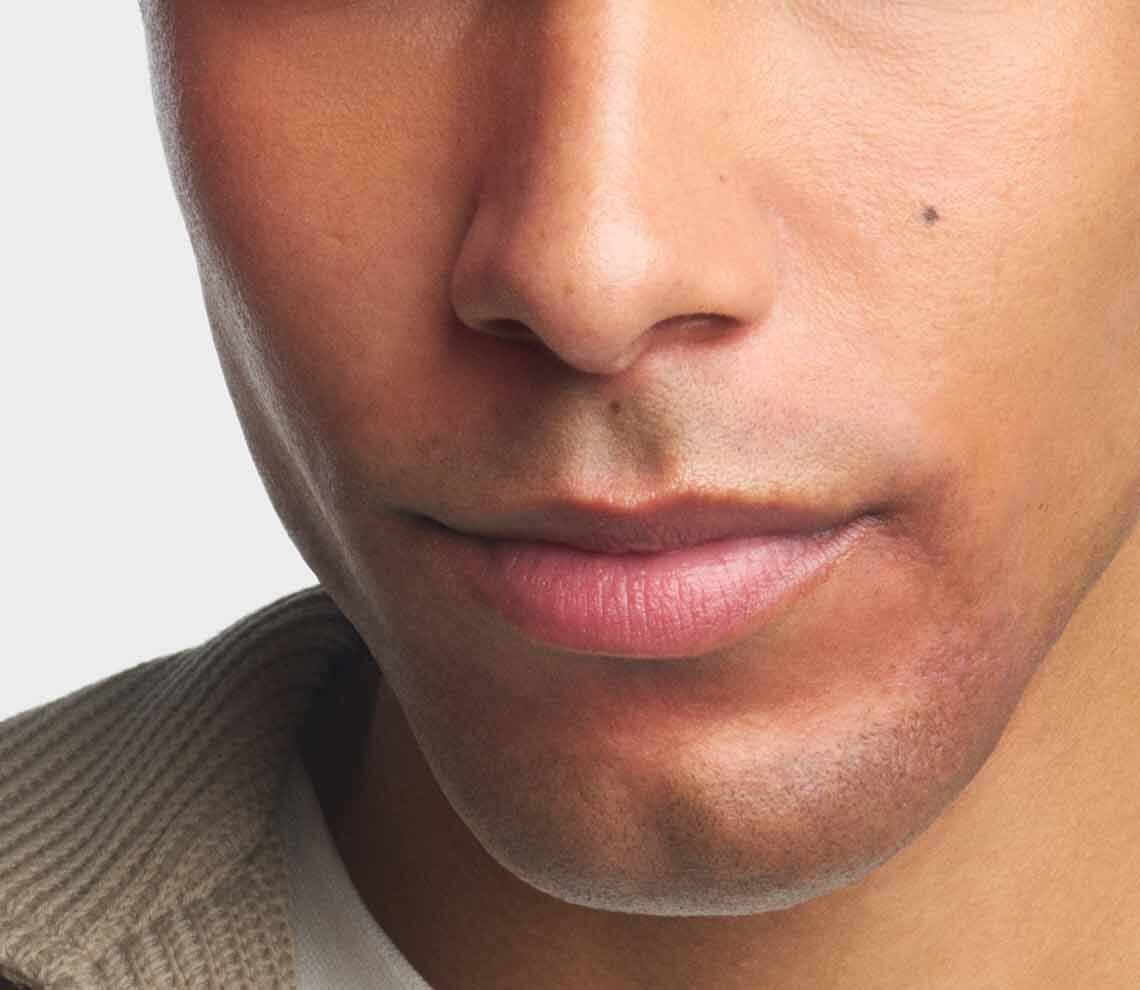 Close-up of facial skin showing mild redness and texture variations associated with rosacea-prone skin