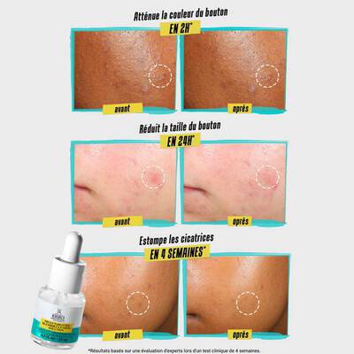 Bild zeigt eine Vergleichsgrafik mit Hautveranderungen. Oben sind zwei Bilder vor und nach der Anwendung eines Produkts, das die Rotung in 2 Stunden mildert. In der Mitte werden die Ergebnisse nach 24 Stunden fur die Milderung von Pickeln gezeigt, und unten sind die Fortschritte nach 4 Wochen fur