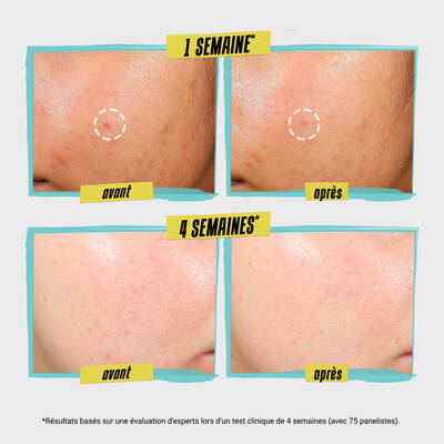Images comparatives montrant l'evolution de la peau apres une semaine et quatre semaines de traitement, avec des zones marquees "avant" et "apres".