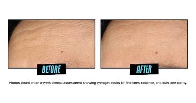 Before and after images of skin texture, showing smoother skin in the 'after' image compared to the 'before' image, with labels indicating "Vorher" (Before) and "Nachher" (After).